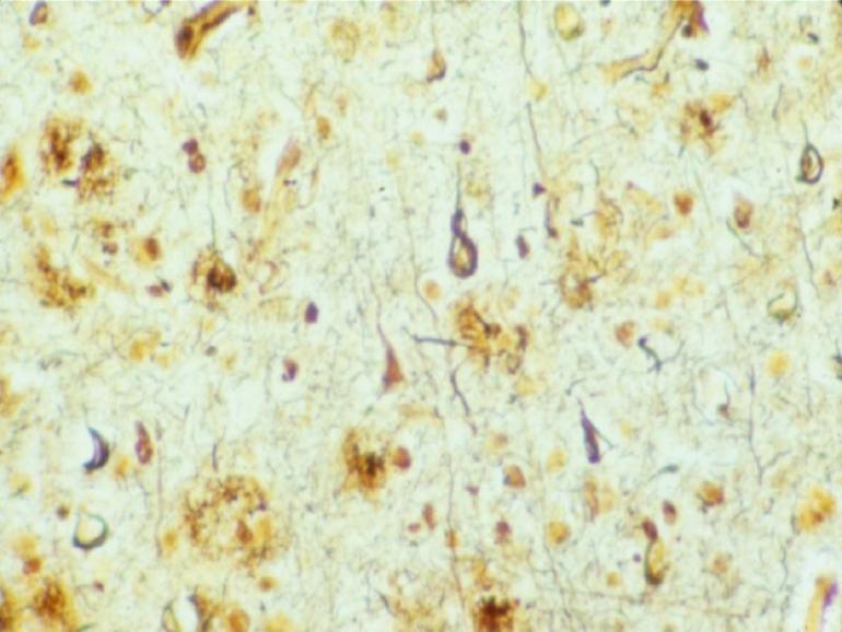 Placche senili e degenerazioni neurofibrillari