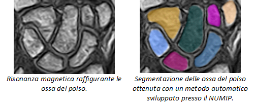 risonanza e segmentazione osso